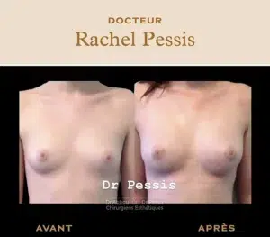 lipofilling seins