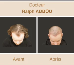greffe-de-cheveux-avant-apres