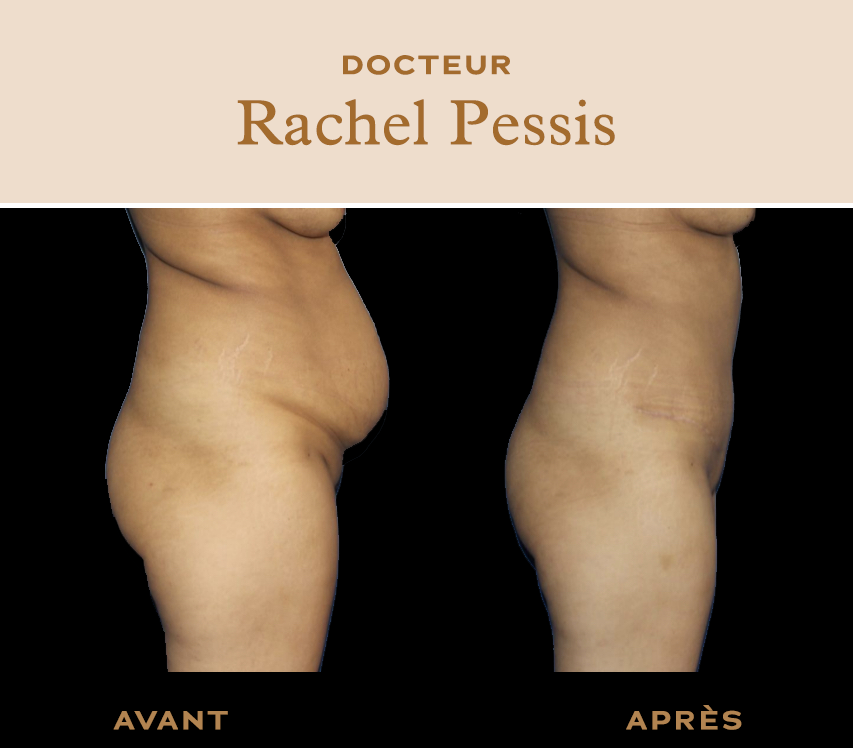 Abdominoplastie à Paris dr Abbou