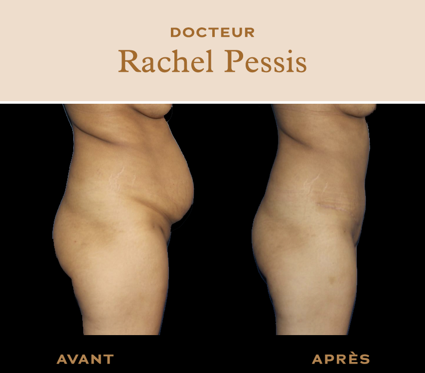 Gaine Après Abdominoplastie