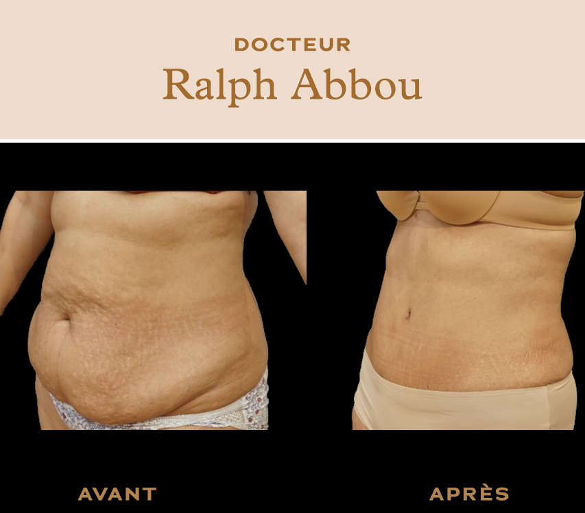 Abdominoplastie à Paris. Lifting du ventre Dr Pessis et Dr Abbou