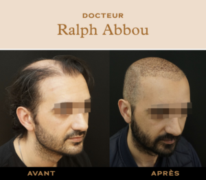 Greffe de cheveux à Paris dr ralph abbou