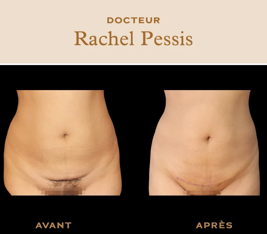 Abdominoplasty or tummy tuck : abdominal surgery in Paris