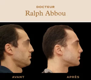 rhinoplastie ultrasonique