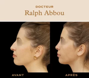 rhinoplastie ultrasonique paris
