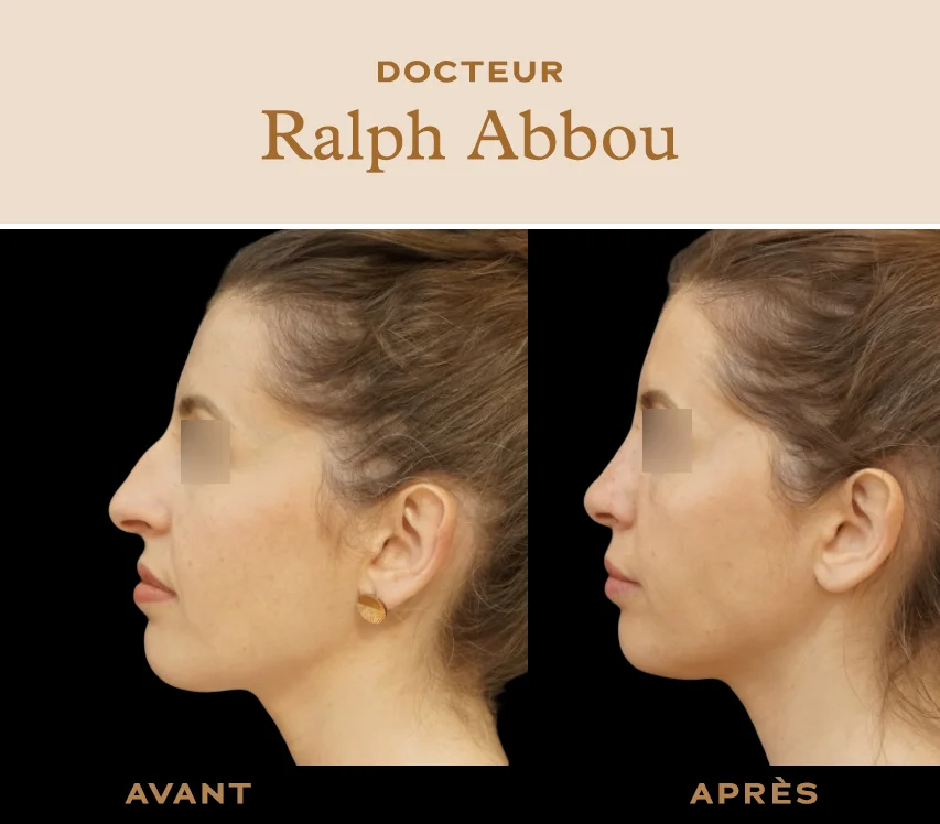 Prix d'une rhinoplastie en france