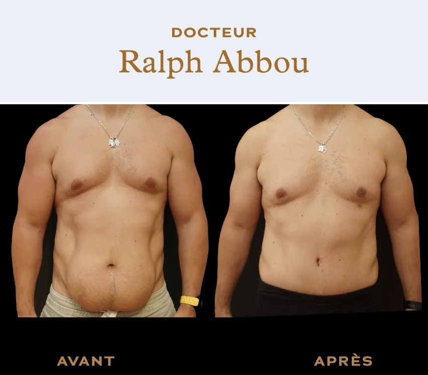 Before / After : Abdominoplasty - Dr Abbou