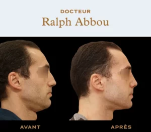 Ultrasonic rhinoplasty paris dr abbou