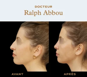 Ultrasonic rhinoplasty paris dr abbou