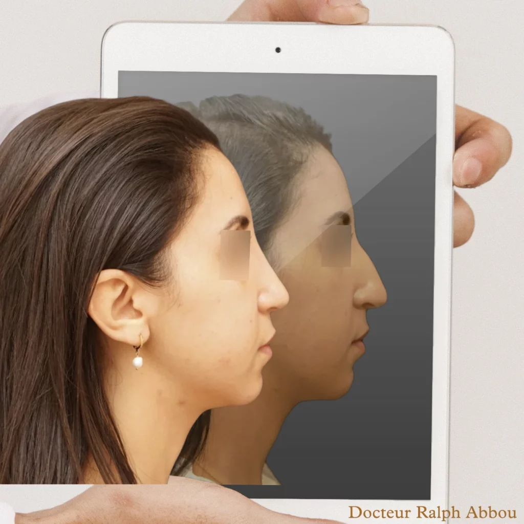 rhinoplastie ultrasonique paris dr abbou