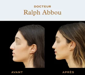 Ultrasonic rhinoplasty paris dr abbou