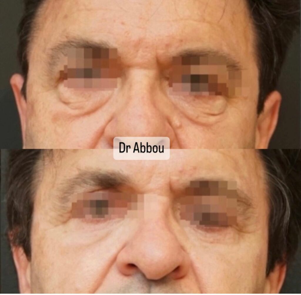 Traitement des poches malaires à Paris. Dr ABBOU — free download