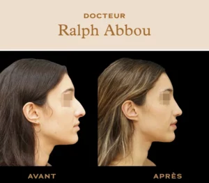 rhinoplastie ultrasonique paris