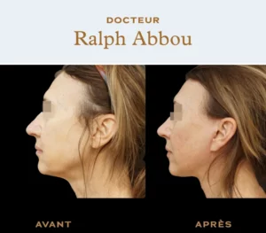 Facelift Paris