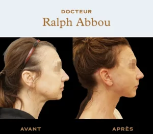 Facelift Paris
