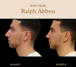 rhinoplastie ultrasonique paris