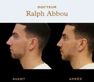 Ultrasonic rhinoplasty Paris dr abbou