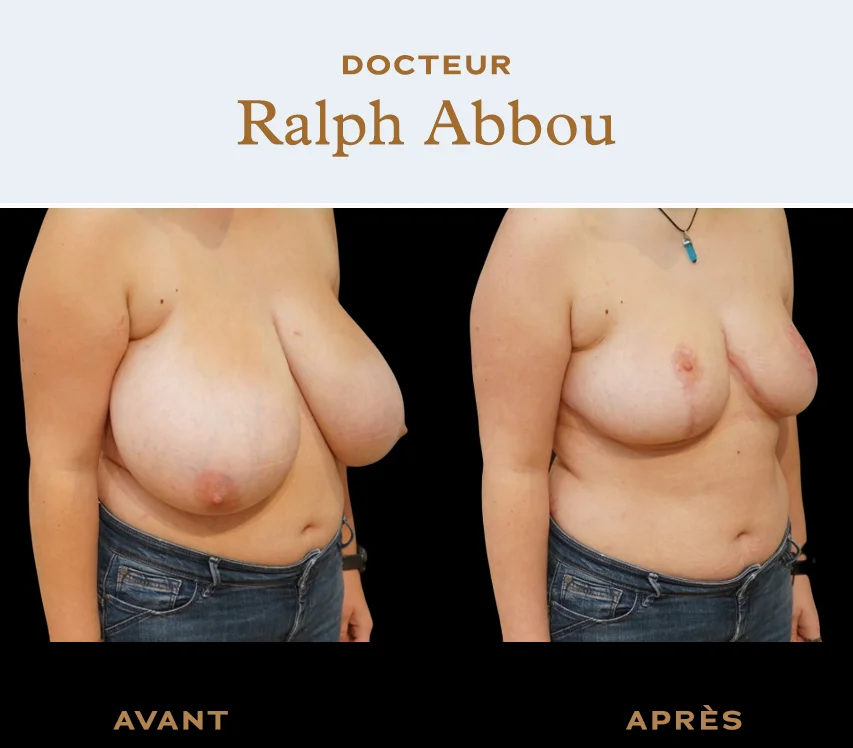 Before / After : Breast reduction - Dr Abbou