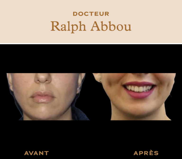 Chirurgie des fossettes à Paris. Dimpleplasty Dr Ralph Abbou