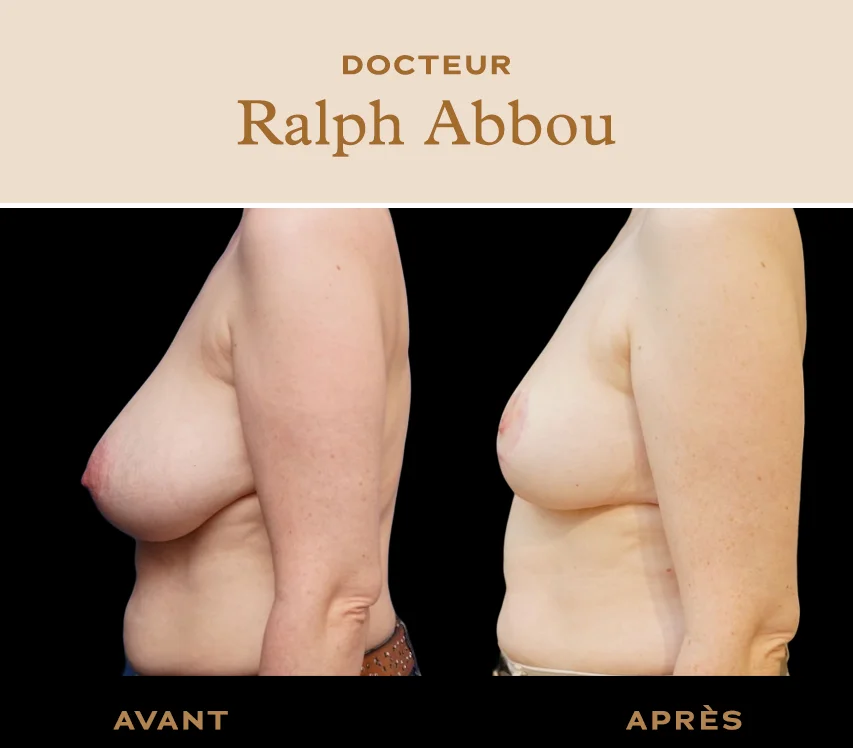 Before / After : Breast reduction - Dr Abbou