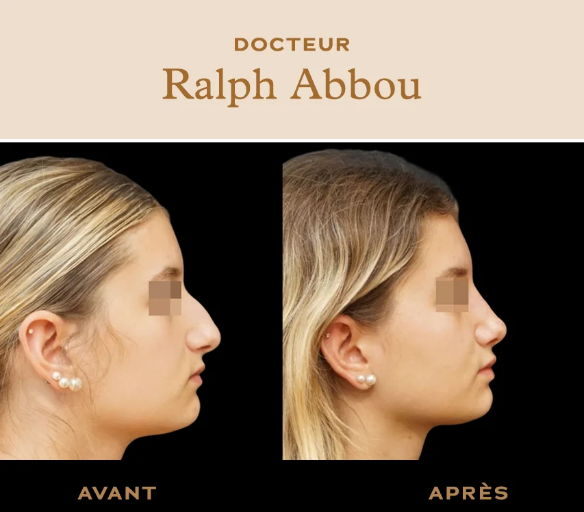 rhinoplastie ultrasonique paris dr abbou