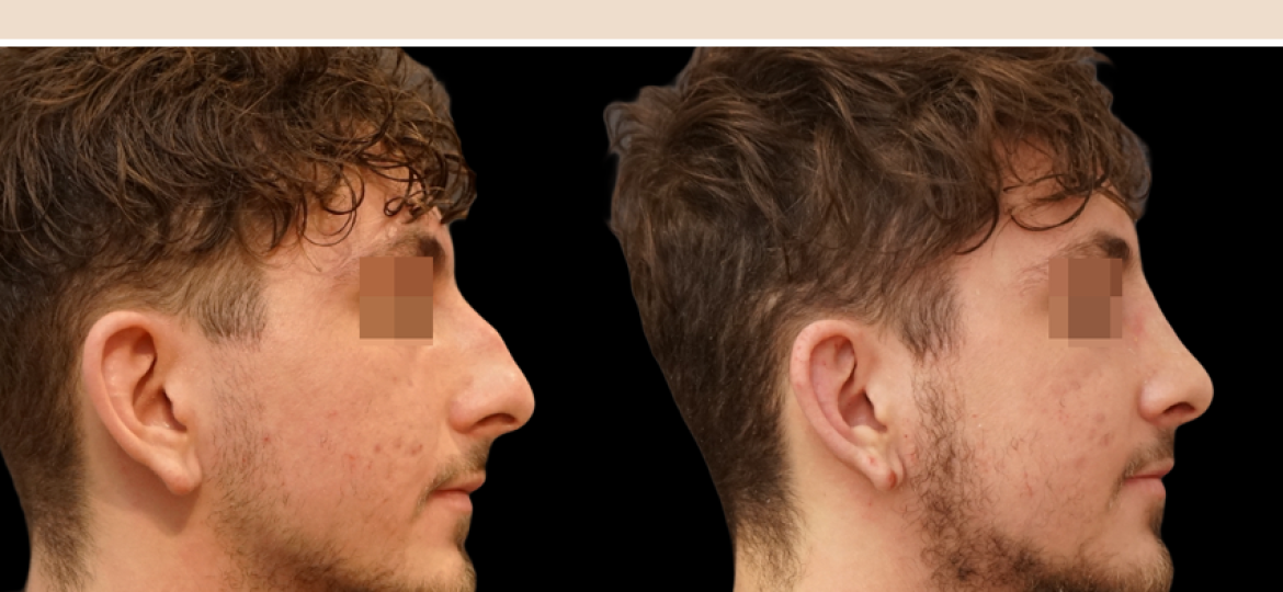 rhinoplastie ultrasonique paris dr abbou