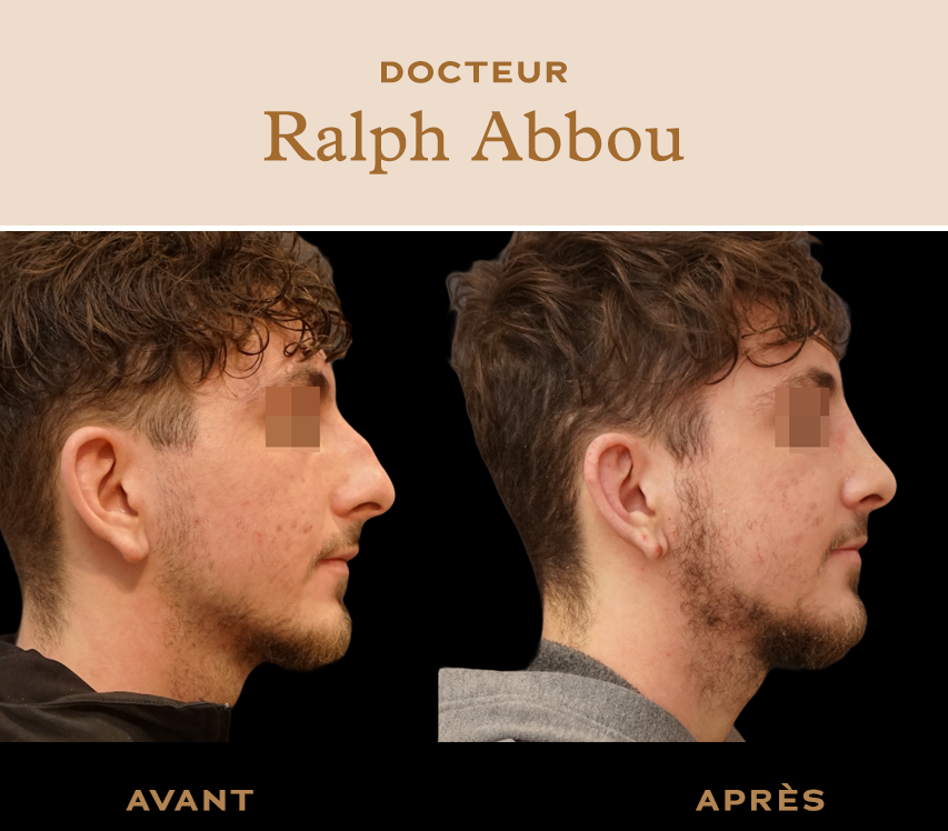 rhinoplastie ultrasonique paris dr abbou