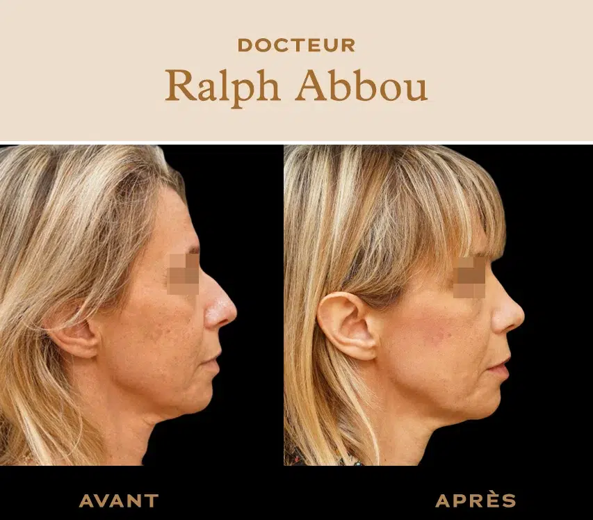 rhinoplastie ultrasonique paris dr abbou