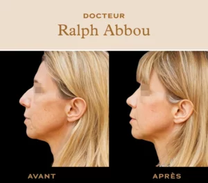 rhinoplastie ultrasonique paris dr abbou