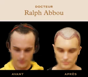 Greffe de cheveux à Paris dr ralph abbou