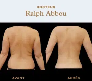 Back liposuction in Paris