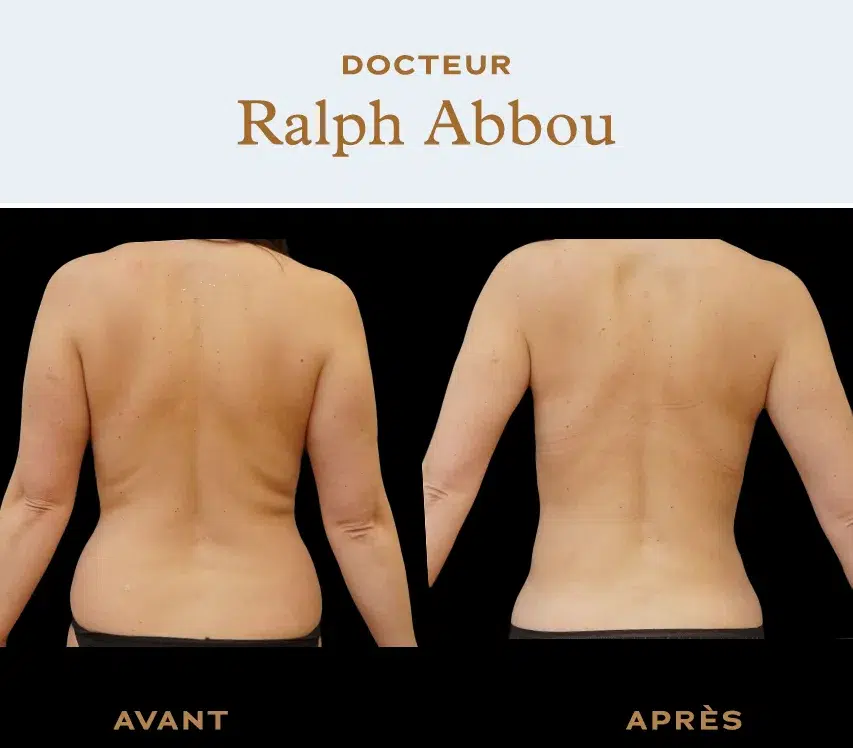 Back Liposuction: Back Fat Removal