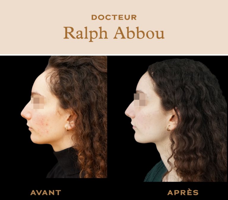Reduction du front. Abaissement ligne frontale Paris Dr Abbou