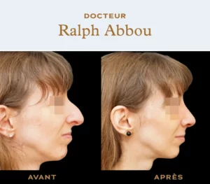 Rhinoplasty