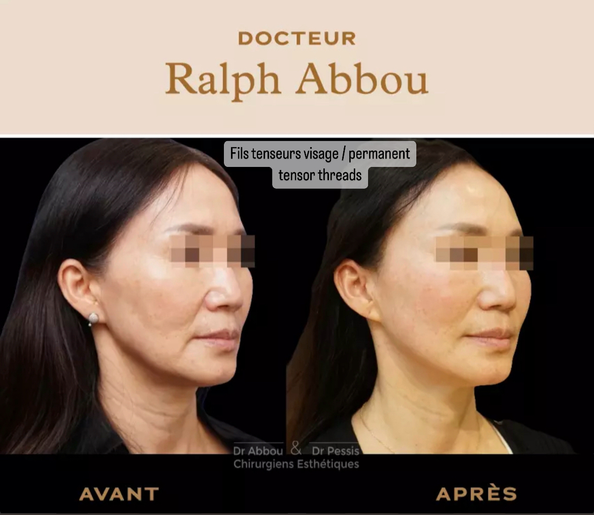 Fils tenseurs Paris. Dr ralph Abbou Chirurgie esthétique