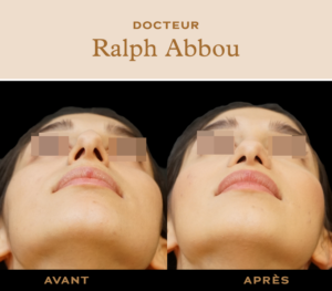 Réduction des narines Paris