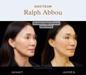 Before / After : Facelift with permanent tensor threads - Dr Abbou