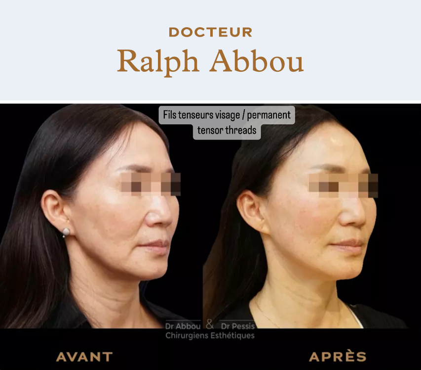 Thread & Lift - The 1st real facelift without surgery