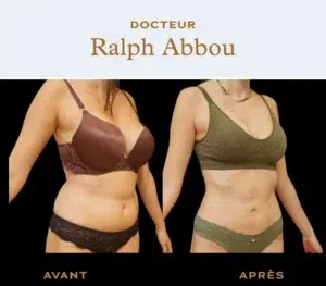 Liposuction in Paris