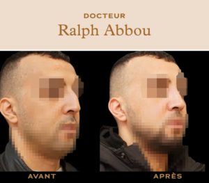 rhinoplastie ultrasonique paris