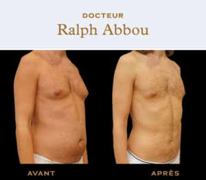 Belly liposuction dr ralph abbou