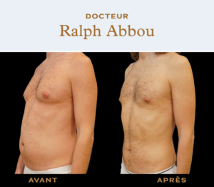 Belly liposuction dr ralph abbou