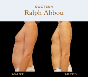 Belly liposuction dr ralph abbou