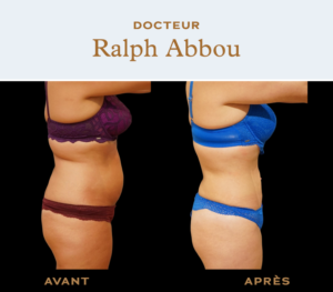 Belly liposuction dr ralph abbou