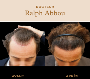 Greffe de cheveux à Paris