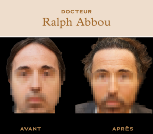 Greffe de cheveux à Paris