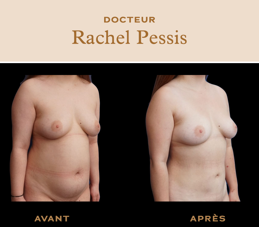 liposuccion ventre paris