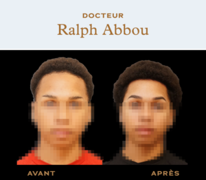 Forehead reduction Paris