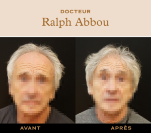 greffe de cheveux Paris