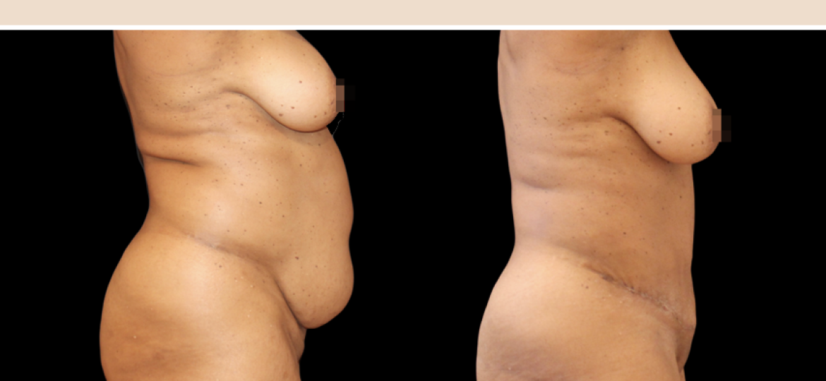 Abdominoplastie Paris
